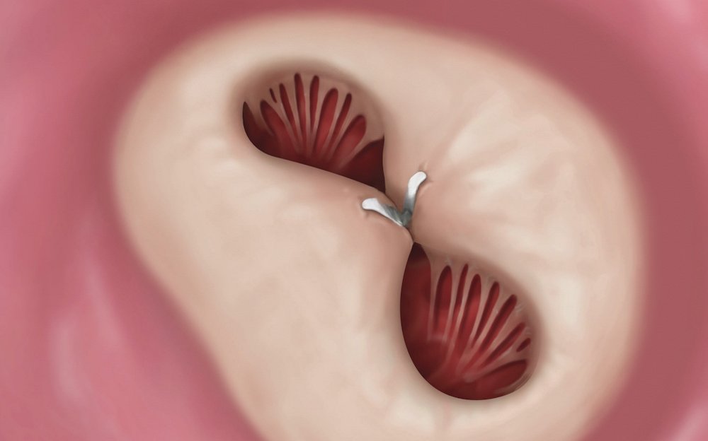 Finishing the procedure